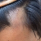 trichotillomania wigs tupelo ms
