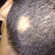 Alopecia Areata treatment, Tupelo Mississippi