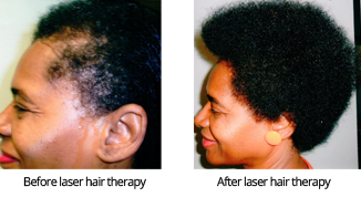 Laser Hair Therapy for Women