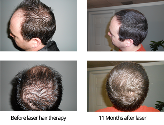Laser Hair Therapy for Men