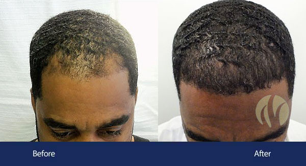 laser hair loss treatment tupelo ms