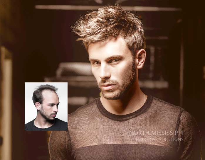 Mens hair restoration replacement tupelo mississippi